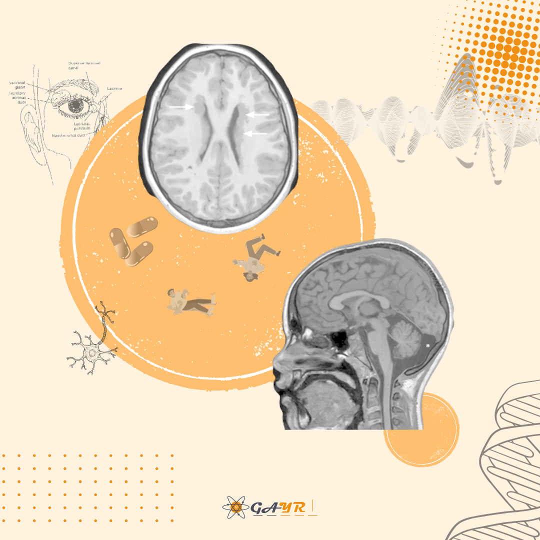 A Rare Presentation of Bilateral Periventricular Nodular Heterotopia with Intra-axial Pontine Lesion: A Case Report and Treatment Approach