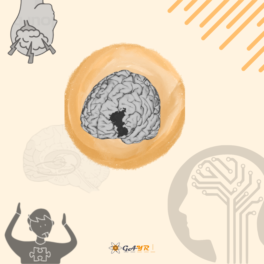 A systematic review and meta-analysis for the efficacy of transcranial direct current stimulation (tDCS) in OCD treatment: A non-pharmacological approach to clinical interventions